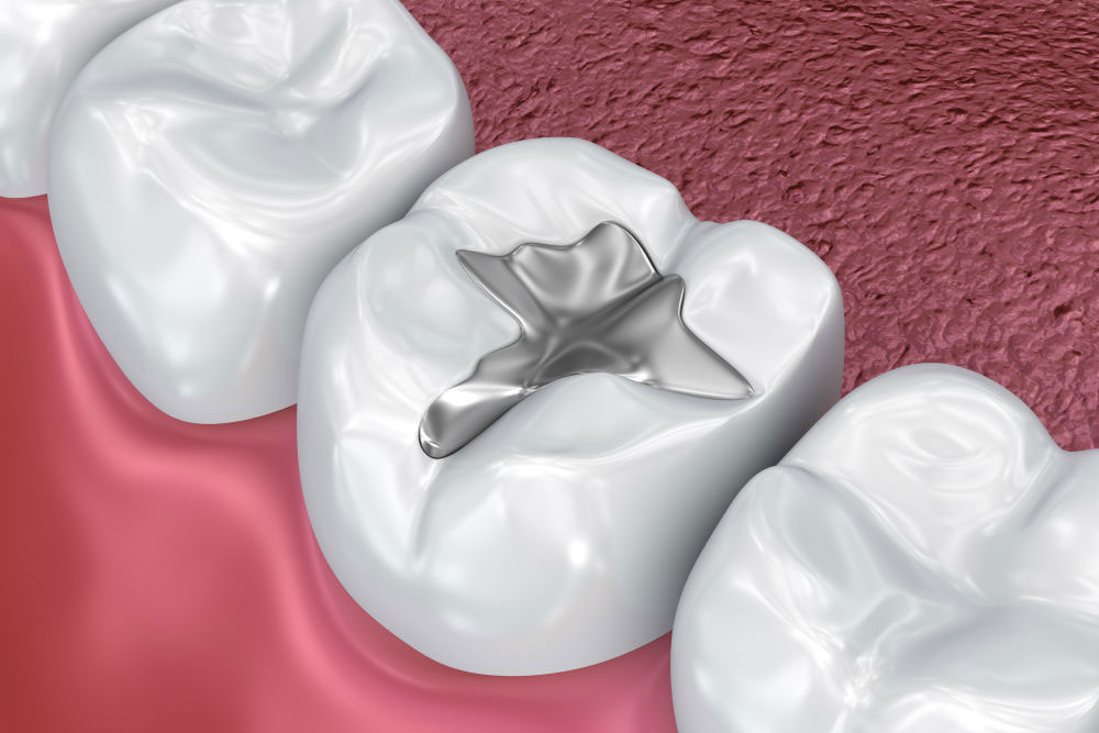 5 reasons you may need dental Filling