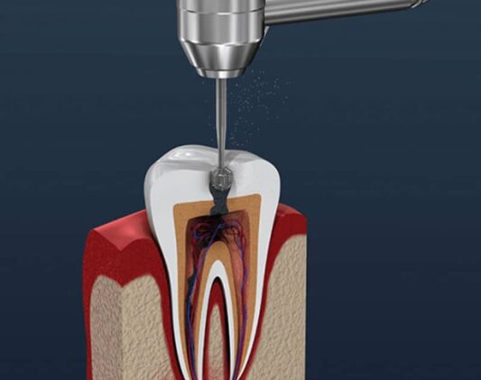 Root Canal treatment