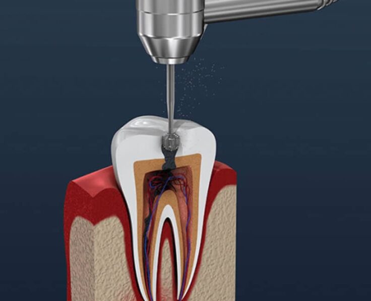 root-canal-treatment-therapy