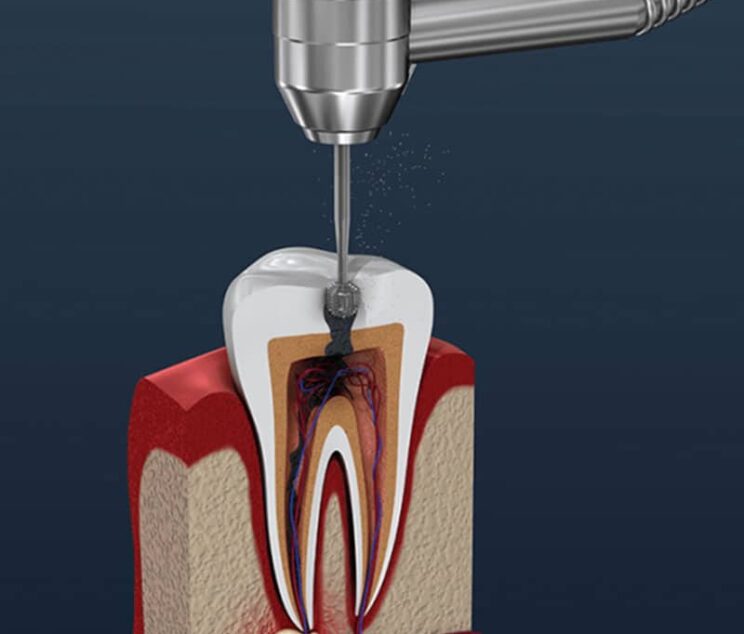 Root Canal treatment