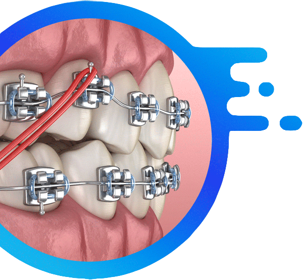 dental-braces-karen-dental-nairobi