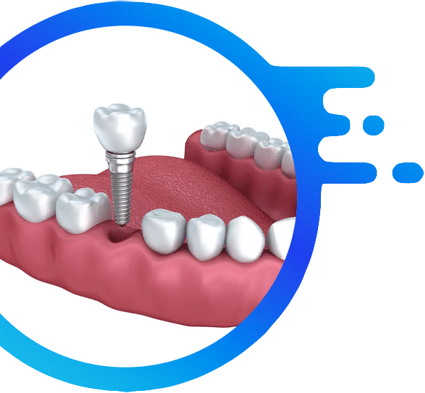 dental-implants-karen-dental-nairobi