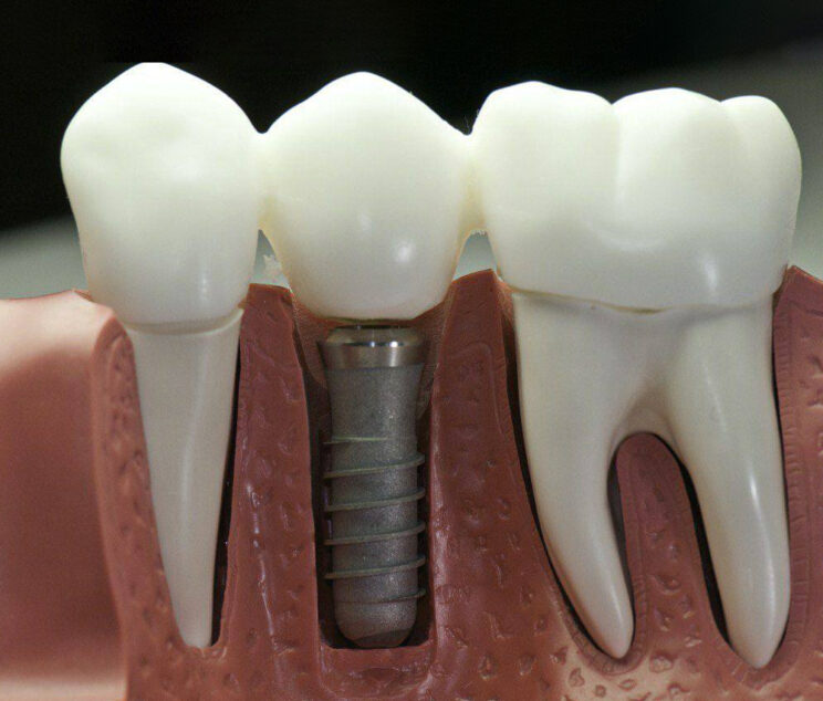 Dental Implant