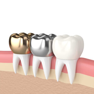 dental-crowns