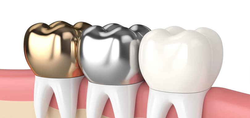 dental-crowns