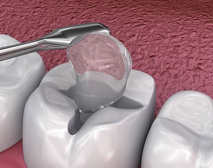 dental-filling