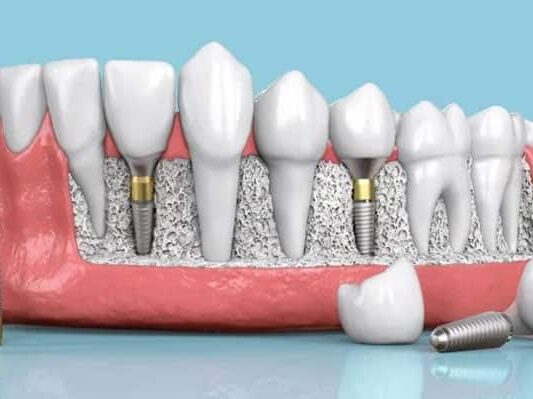 Dental implants Nairobi
