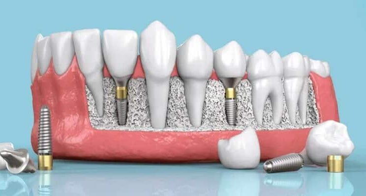 Dental implants Nairobi
