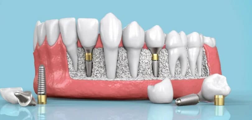 Dental implants Nairobi