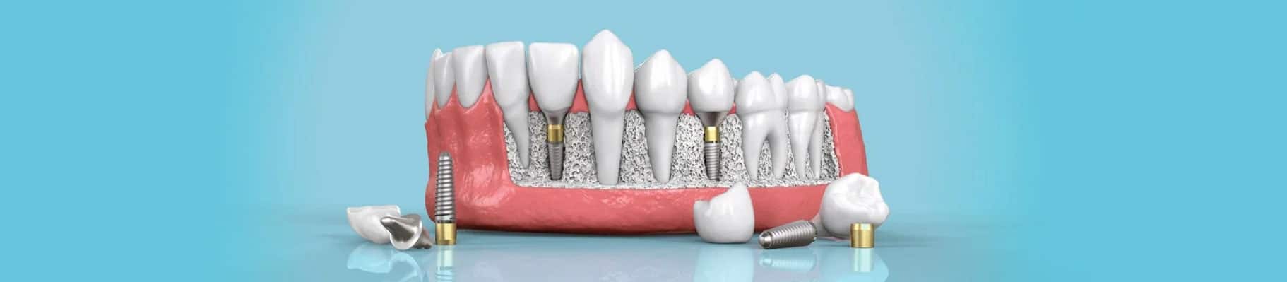 Dental implant Nairobi
