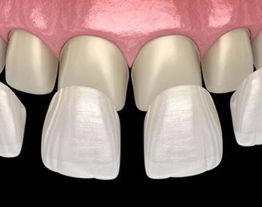 dental veneers in Nairobi