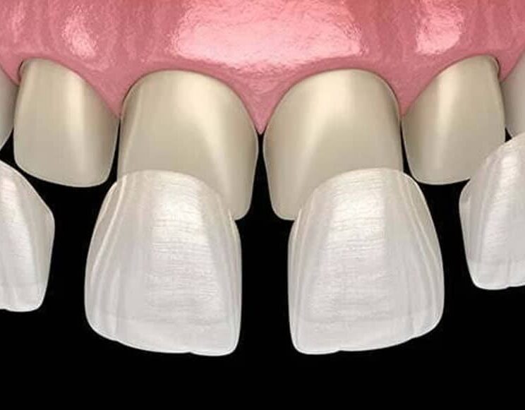 dental veneers in Nairobi