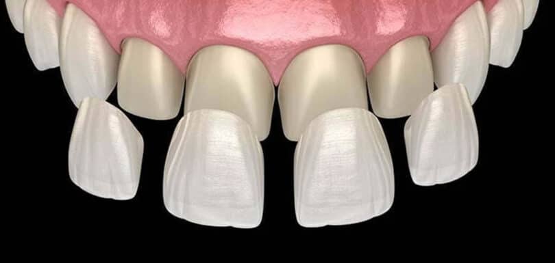 dental veneers in Nairobi