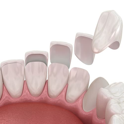 dental-veneers-karen-dental-clinic