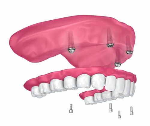 dental implants vs bridges vs dentures