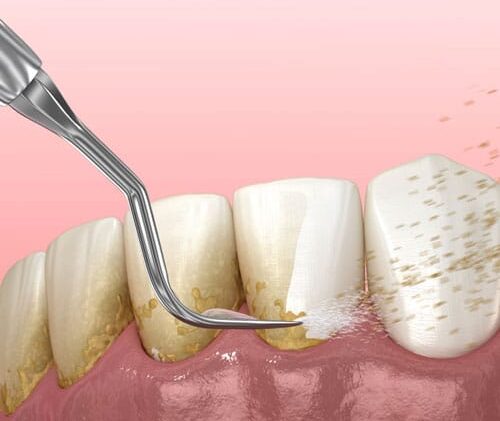 Teeth-Dental Cleaning