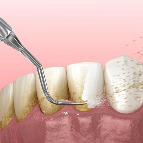 teeth-cleaning-karen-dental