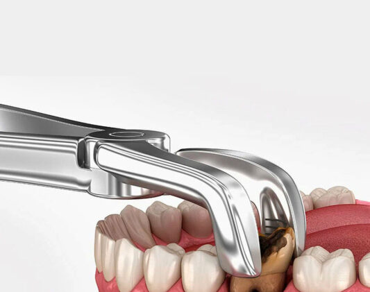 wisdom tooth removal Kenya-Karen Dental Clinic
