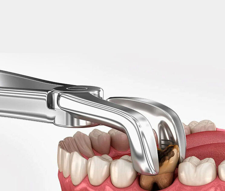 Tooth Removal-Karen Dental Clinic