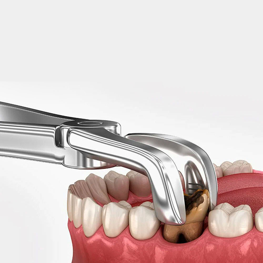 Tooth Removal-Karen Dental Clinic