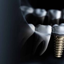 Dental Implants