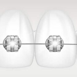 Dental braces