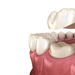 dental-crowns-wide