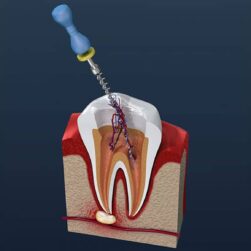 root-canal-treatment